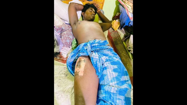 செல்போன் வெடித்து இளைஞர் படுகாயம்!